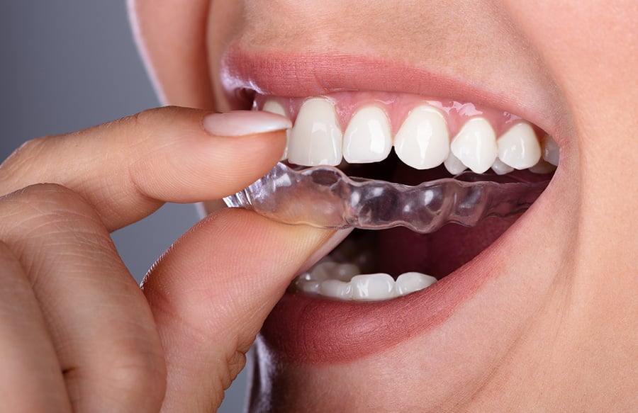 Clear aligners in Darien, IL