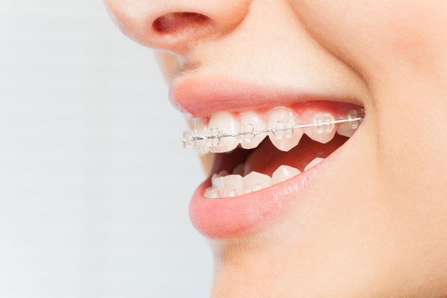 Clear and ceramic braces in Darien, IL