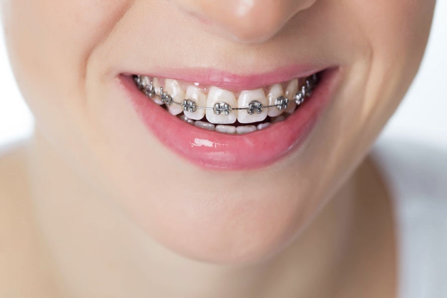 Traditional braces in Darien, IL 60561