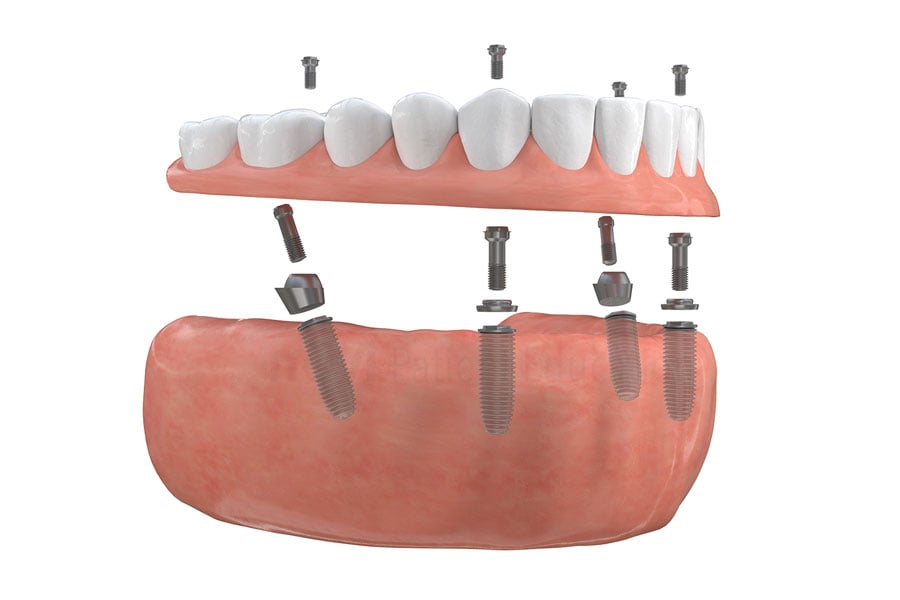 Darien, IL dental implants for missing teeth from a dental expert team. Dental Implants in Darien, IL
