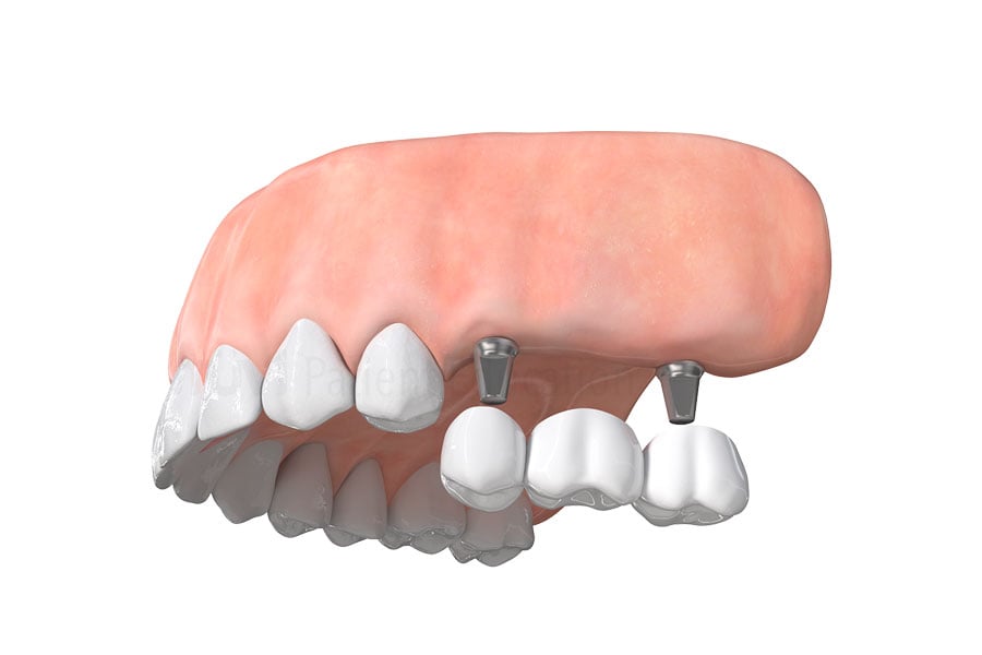 Dental Bridges