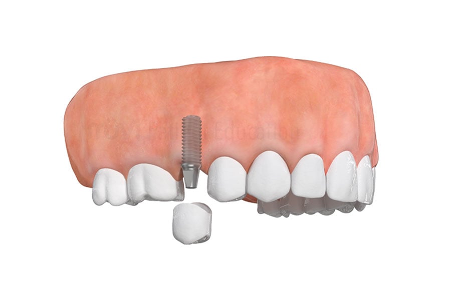 Dental Implants