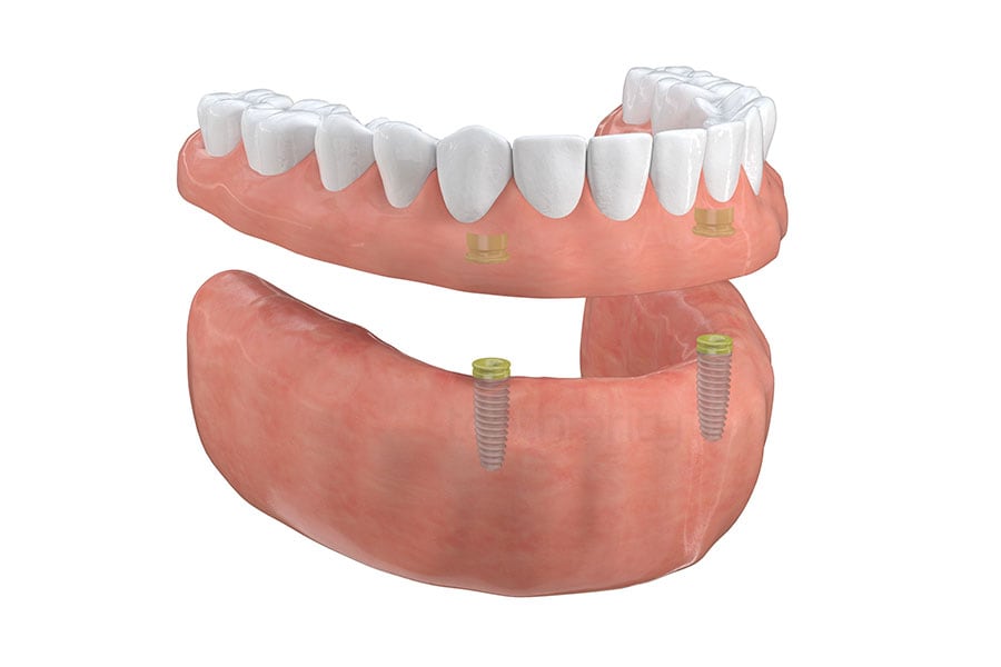 Implant-Supported Overdentures