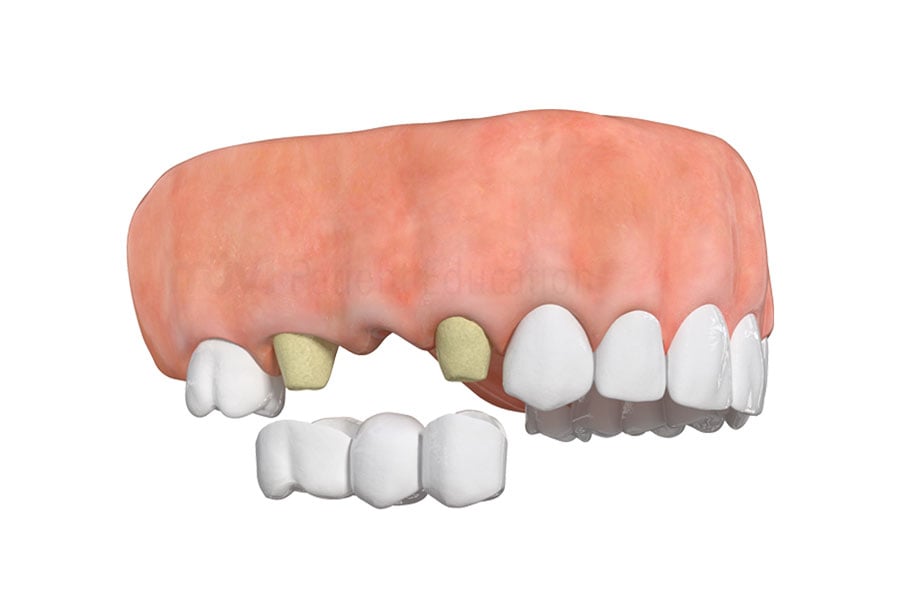 Dental Bridge